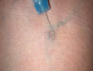 Sclerotherapy normal surface view